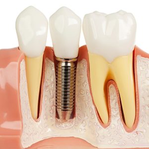 طول عمر ایمپلنت سوئیسی چقدر است ؟