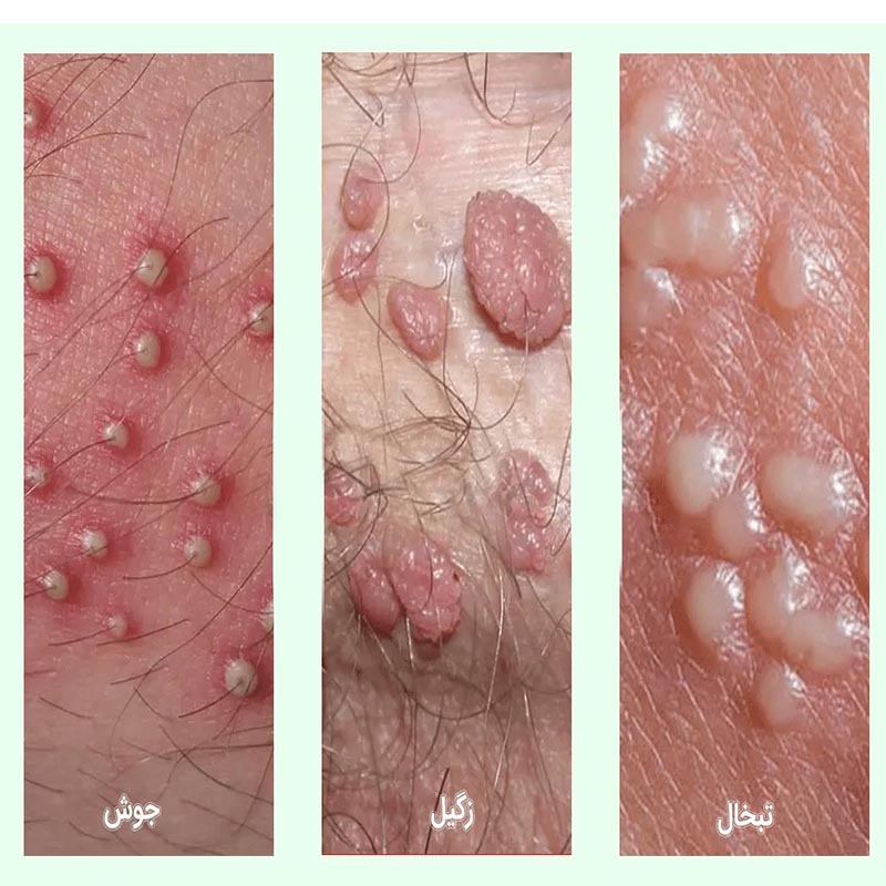 علائم پاره شدن بکارت+پارگی پرده بکارت با انگشت+ از کجا بفهمیم زگیل تناسلی داریم