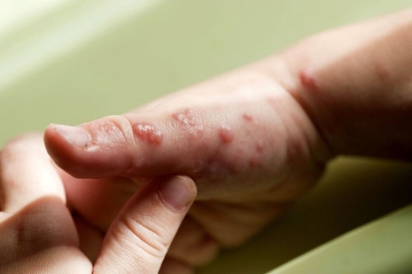 چه زمانی پس از ابتلا به آبله مرغان پزشک مراجعه کنیم؟