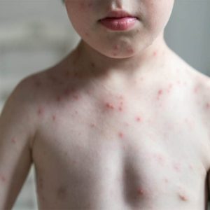 جوش‌های آبله مرغان چگونه ایجاد می‌شوند؟ علائم آبله مرغان